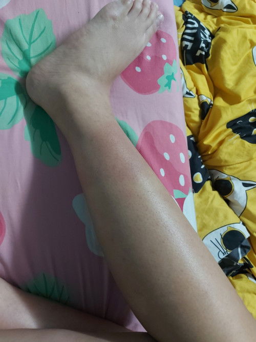 อายุครรถ์ 34w ขาบวมและแดงเป็นจ้ำที่เดิมทุกวัน ผิดปกติไหมคะ