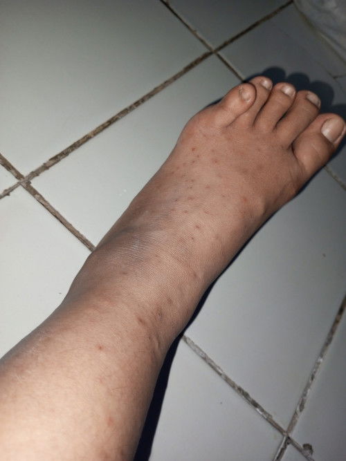 Bumil disini ada yang gatal2 nyampe merah begini di tm 3 ? 
Apa yah obatnya bunda² udah k guat gatel