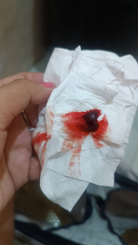 Implantation bleeding or Miscarriage ?