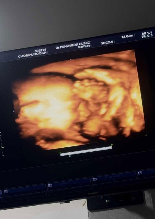 ประสบการณ์ตรวจน้ำตาล 50 กรัม 📌