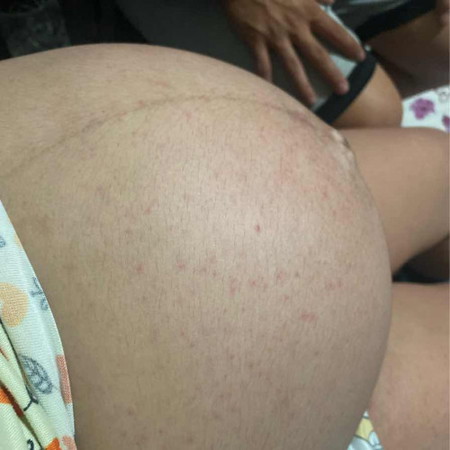 Rashes sa tiyan 34 weeks