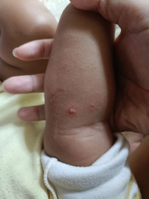 น้องขึ้นผื่น