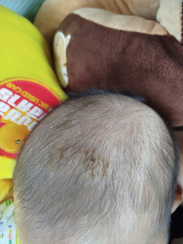 ใช้อะไรถึงจะหายคะ ไม่กล้าแกะออกเลยคะ สระผมวันเว้นวัน