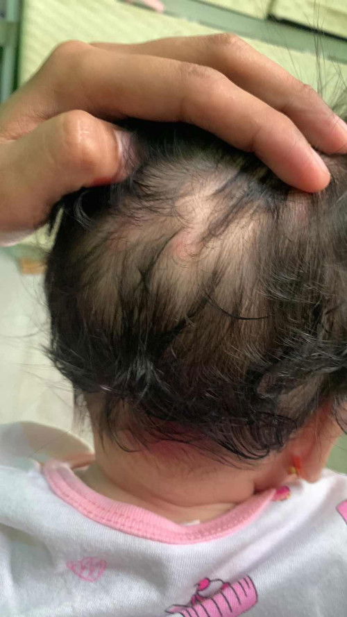 Bukol maliliit sa ulo