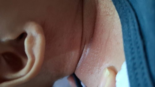 Iritasi atau biang keringat?