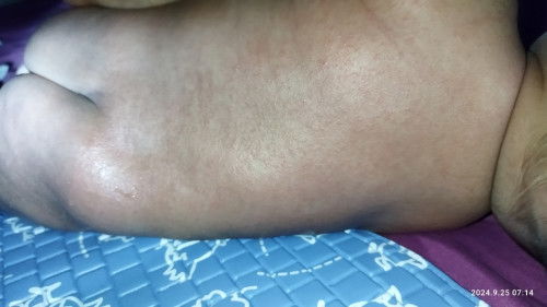 Ruam punggung, alergi atau biang keringat?