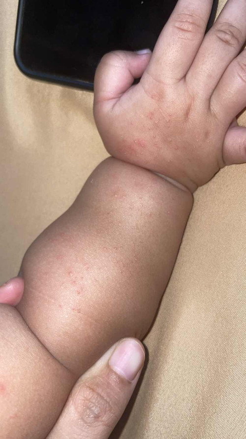 Tolong bayi saya bentol kecil2