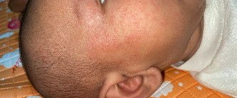 Anak saya kenal ruam panas pada kaki, pipi dan lengan gimana cara penanganannya dok ?