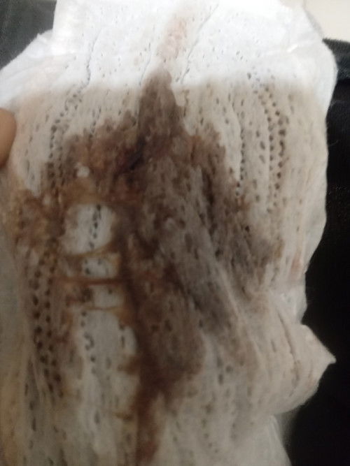 แบบเนี้ย ใช่มูกเลือดรึป่าวคะ พอดีตอน10โมงโดนกระตุ้นมาหลังจากนัดมีเลือดสดออกสักพักมีแบบนี้และปวดท้อง