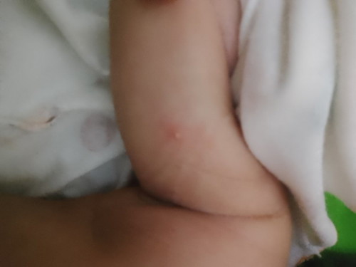 Bun mau Tanya ini di tubuh anak ku ada bintik merah2 truss ada berapa yg seperti jerawat gitu bintik