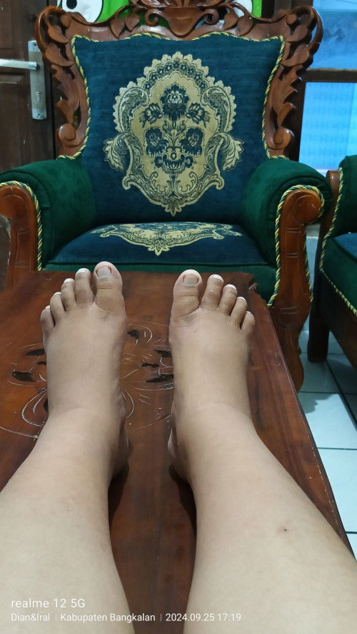 Kaki bengkak