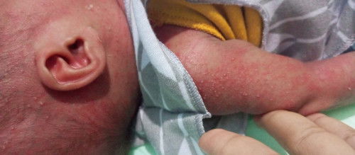 bentol kecil berisi pada seluruh badan bayi newborn