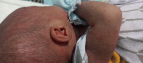 bentol kecil kemerahan pada seluruh badan bayi
