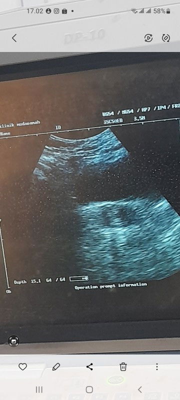 BINGUNG DENGAN HASIL USG