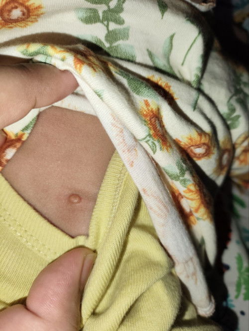 benjolan kecil swperti jerawat di punggung bayi