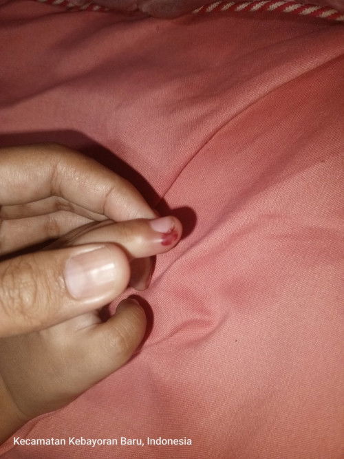 Jari anak bengkak / tidak