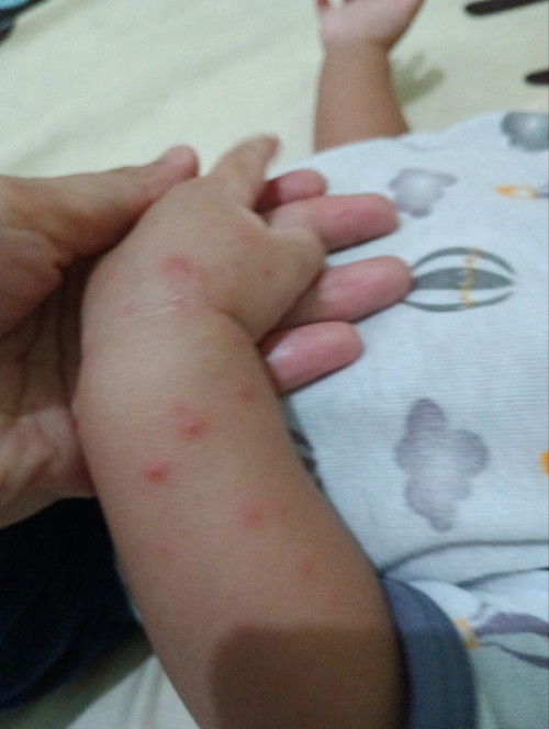 Bintik Merah Di tangan