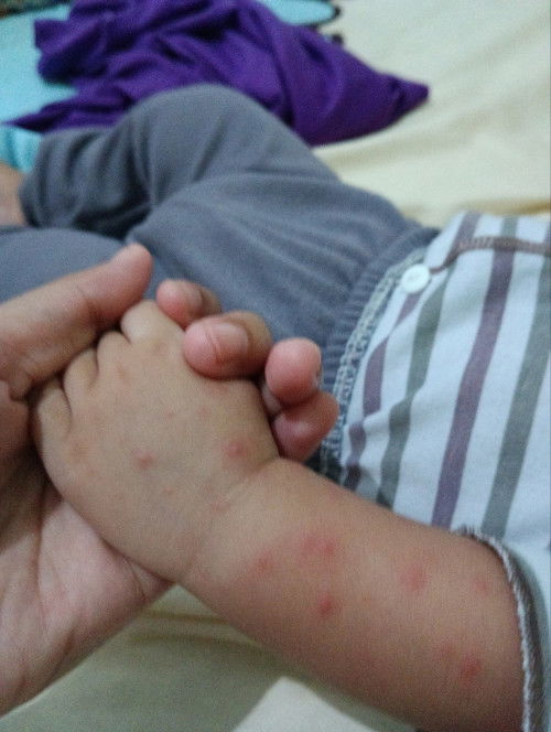 Bintik gatal merah di kulit