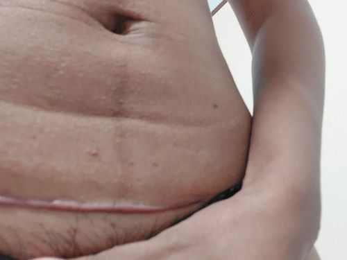 แผลคีลอยด์หลังผ่าคลอด