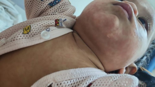 Demam dan ruam lepas vaccine setahun