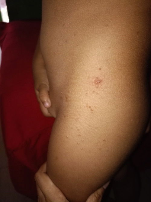 Butlig na makati sa balat