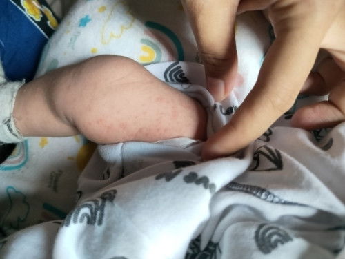 Bintik merah pada bayi