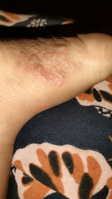 Kaki gatal pada anak 2 tahun yang tk kunjung sembuh