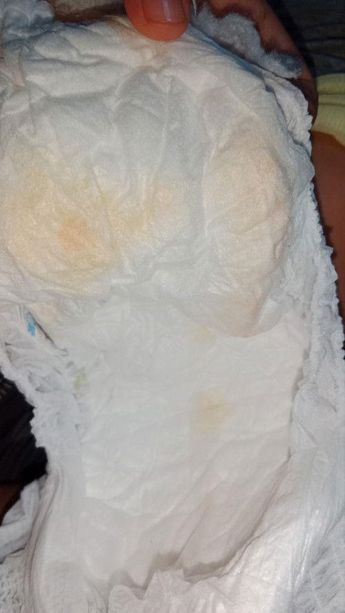 Bun warna urine anak ku seperti ini apakah normal?