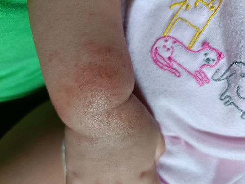 Eczema/Atopic Dermatitis?