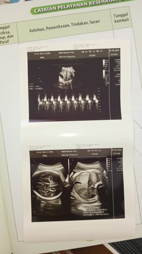36w 3d degdegan rasanya gak sabar mau ketemu dede utun, pertulang belulang udah mulai ngilu² ni