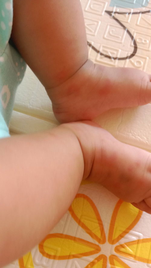 Merah pada bayi 2 bulan