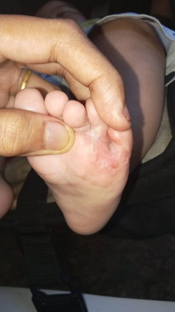 Bund mau nnya ini kira kira kenapa ya,apakah kutu air apa bukan