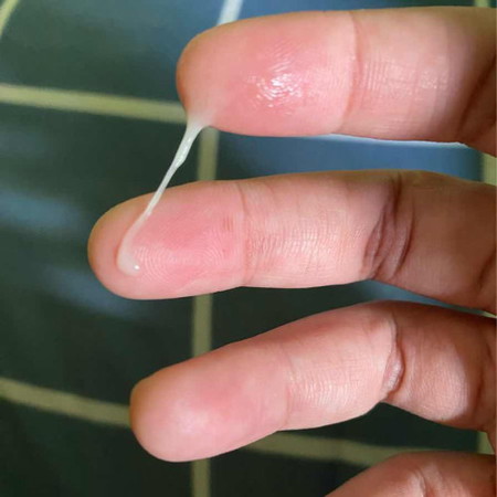 37+1วิค มีมูกแบบนี้ปกติมั้ยคะ