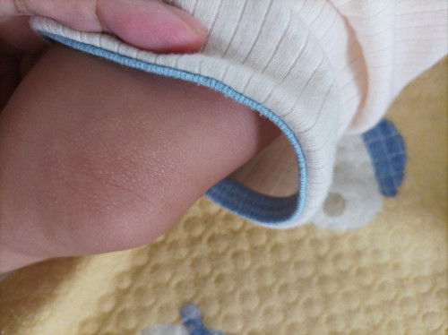 Bintik bintik kasar di kulit bayi