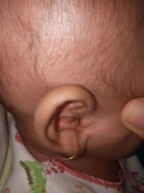 Telinga pada bayi 2 bulan