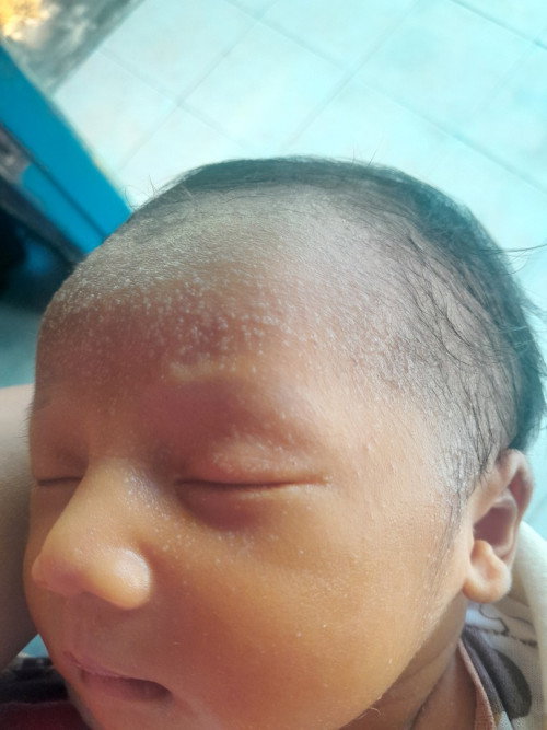 Cara ngatasinnya gimana ya bun takut bgt nambah banyak ,ada yang pernah ngalamin nggak bun anaknya ?