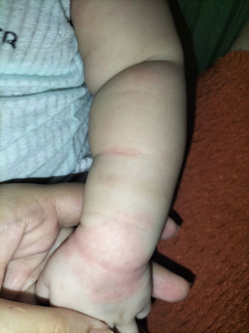 các mom ơi cho e hỏi bé bị như vậy là bị gì vậy ạ.... và giờ trị như thế nào ạ