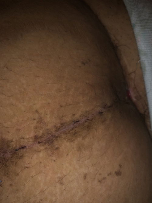 CS SCAR 6 weeks Postpartum