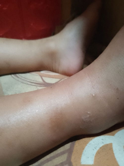 Kaki anak bengkak dan bintik berair.