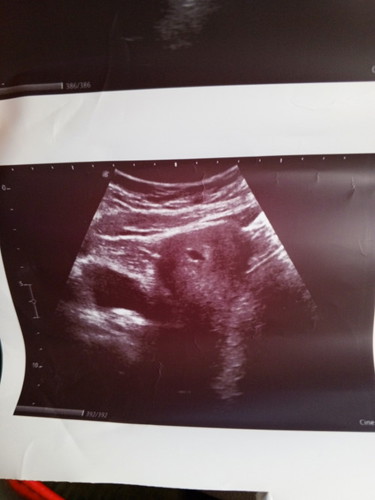 ประจำเดือนมาครั้งสุดท้าย 9/8/67 ซึ่งนับได้7วีค1วัน แต่วันนี้คุณหมอซาวด์ได้5วีค เจอแต่ถุงการตั้งครรภ์