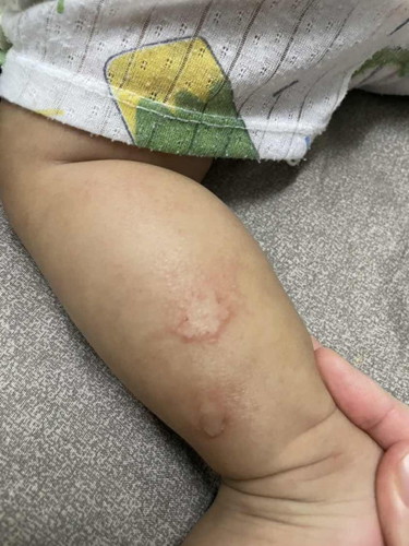 Eczema ke?
