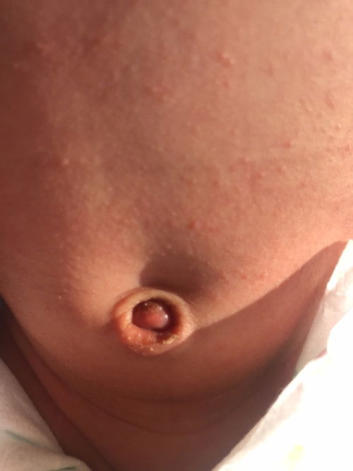 Pusar merah dan bengkak