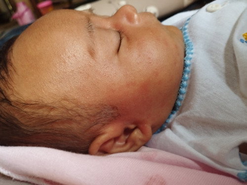 bunda² mau tanya dong ini kulit si kecil merah" gini knp ya?  
maaf newmom soalnya ☺️