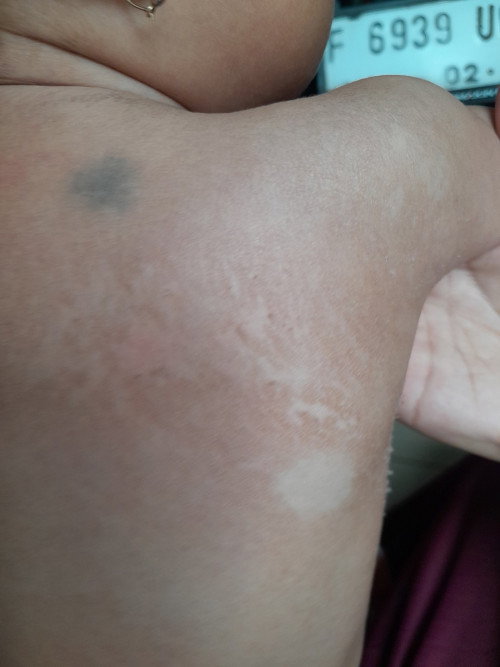 Kulit bayi kering dan mengelupas