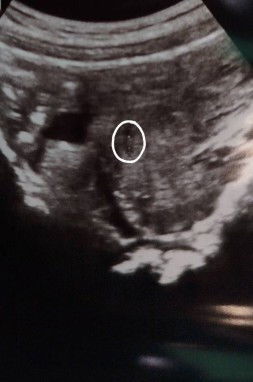 ซาวตอนอายุครรภ์5วีค5วัน