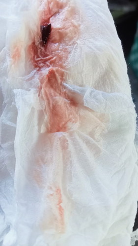 มีเลือดออกแบบนี้