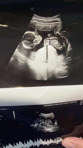 อัลตร้าซาว 18 weeks พอจะทราบเพศน้อง ยังคะ หมอแจ้งว่า อาจจะเป็น ผู้ชายค่ะ