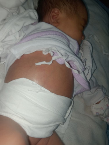 noral lang po ba ang tiyan ng baby q 17days old pa lang po sya