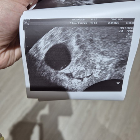 7 weeks scan & empty sac