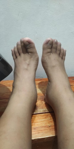 normal poh ba ang pamamanas ng paa sa 17 weeks na buntis???